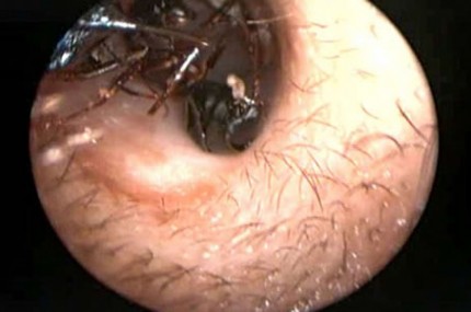 Médicos-encontram-literalmente-um-formigueiro-vivendo-em-cérebro-de-garota-430x285